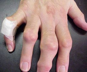 Painful finger joint defects