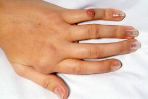 pain in the finger deformity