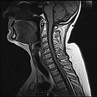 Diagnosis of cervical osteonecrosis