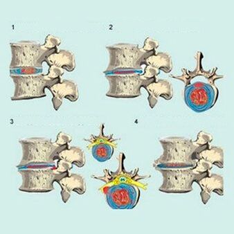 development stages of cervical osteonecrosis