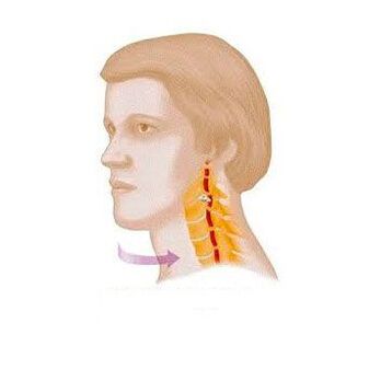 vertebral syndrome with cervical osteonecrosis