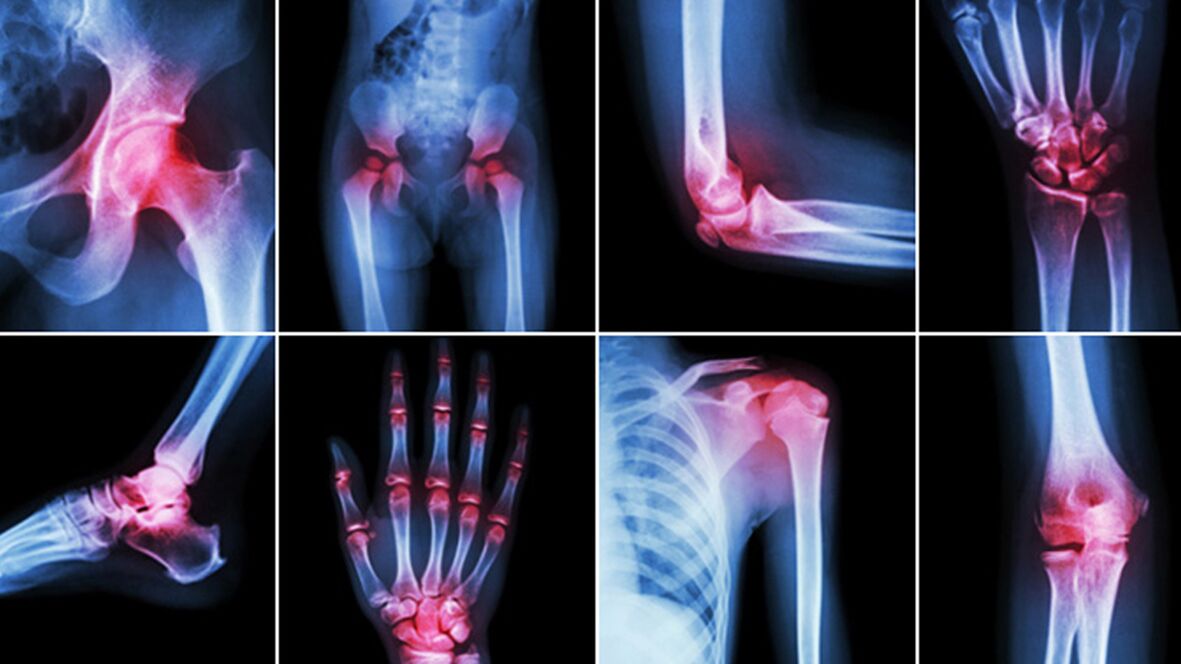 X-rays to relieve joint pain