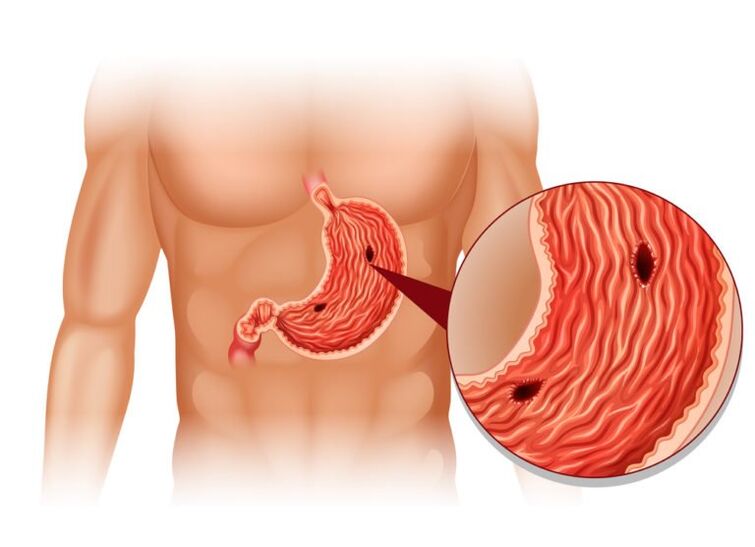 Ulcers are the cause of pain below the left collarbone