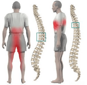 back pain in thoracic osteonecrosis