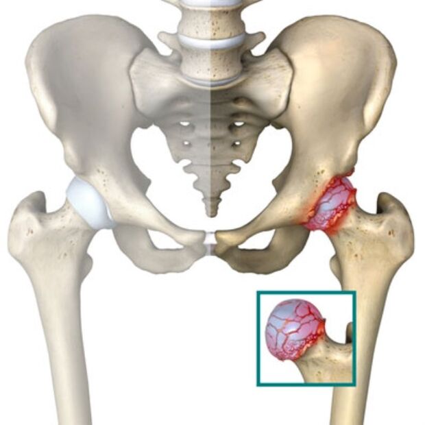 hip arthritis