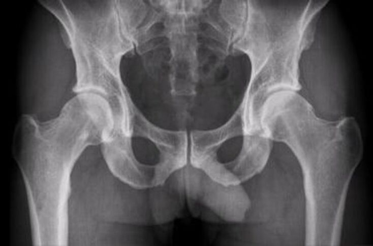 hip x-ray to relieve pain