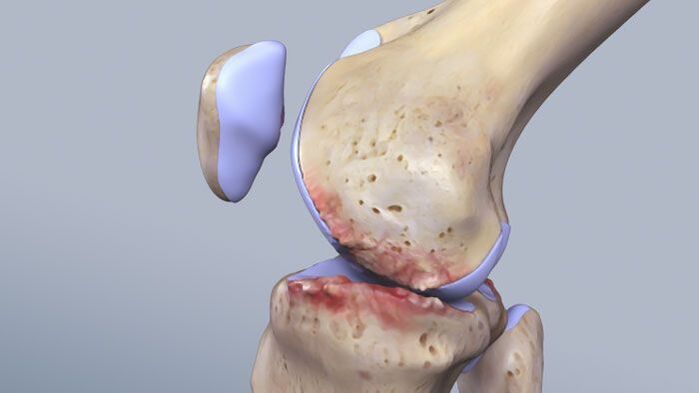 Knee joint structure is affected by pathology