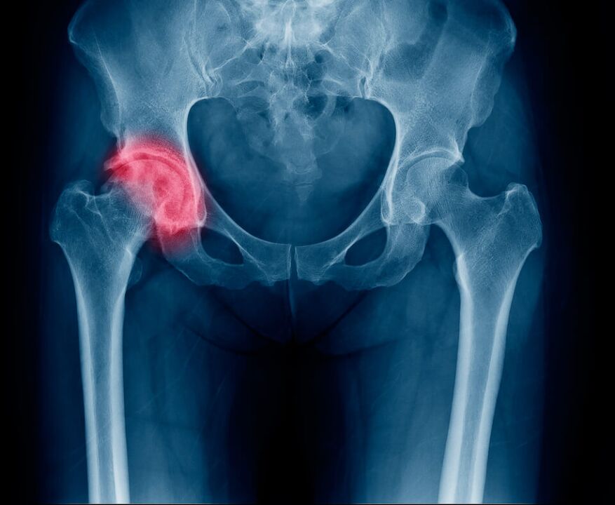 Femoral neck fracture, causing pain radiating down the leg