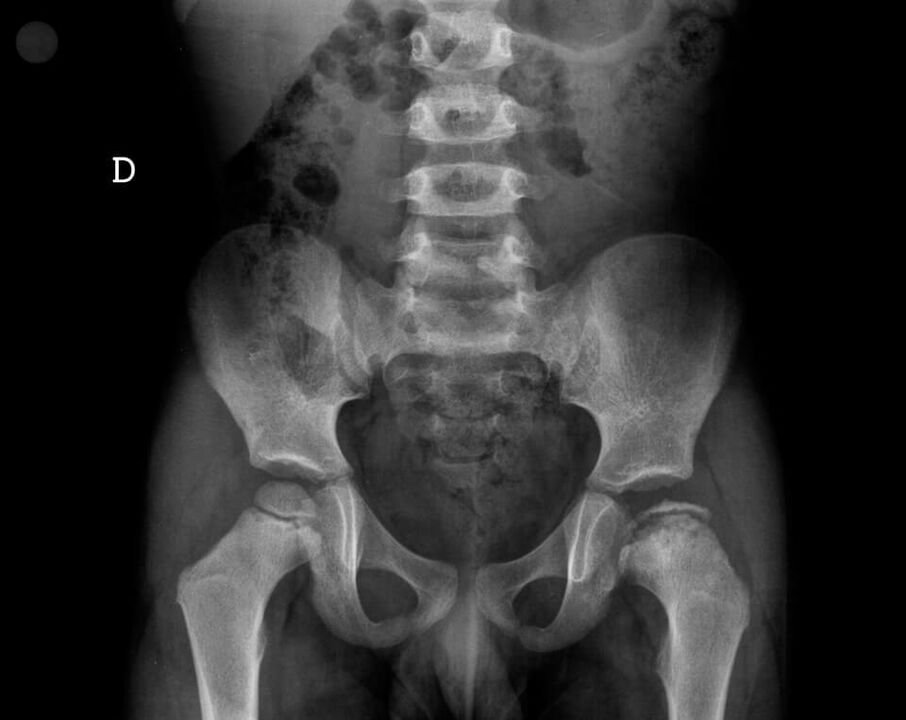 Legg-Calvé-Perthes disease – necrosis of cartilage tissue of the femoral head