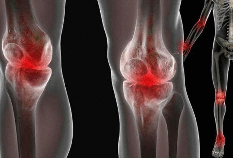 Joint pain in the limbs is caused by many different diseases