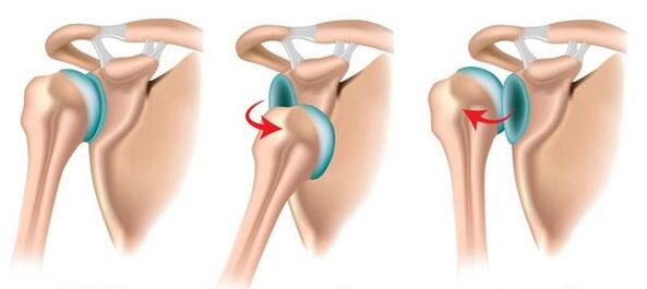 Dislocation of the anterior and posterior shoulder joints, provokes the development of arthritis