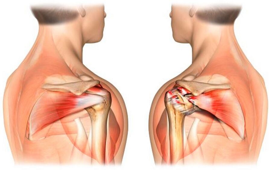 Shoulders are healthy and affected by arthritis