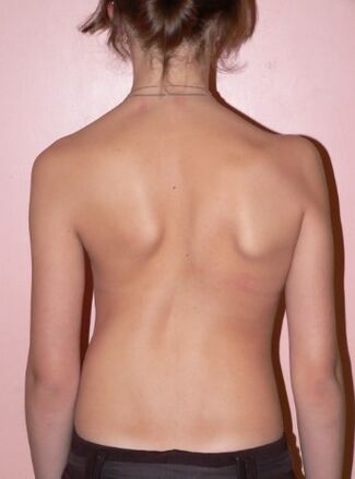 2 -degree scoliosis
