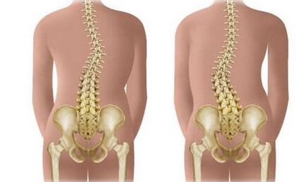 Scoliosis does not