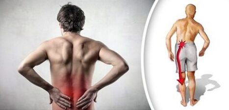 Pain syndrome with lumbar osteoarthritis spreads to the legs