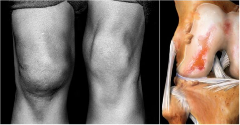 Arthrosis of knee joints and joints