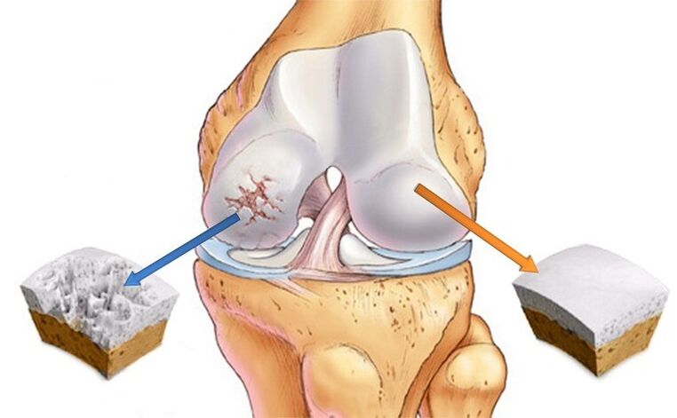 Cartilage is normal and affected by arthritis