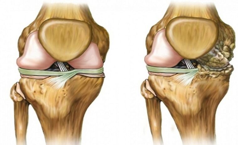 Healthy and affected by joints