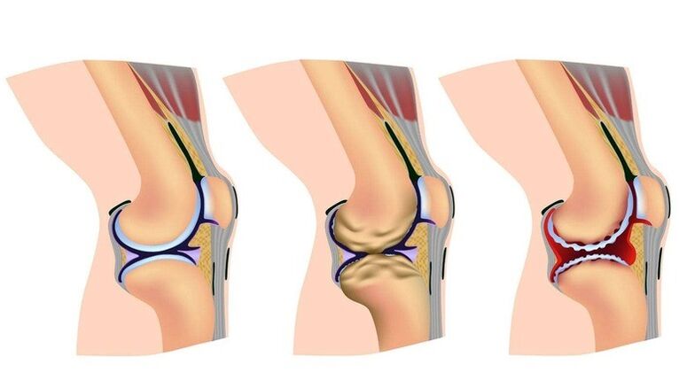 The stages of deformation in the knee joint
