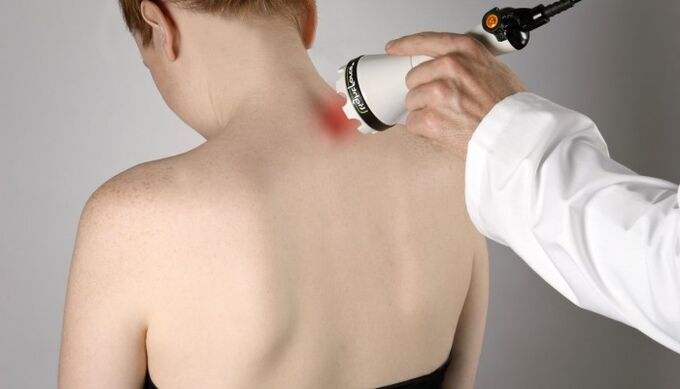 Laser treatment for cervical spondylosis