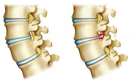 healthy disc and disc herniation