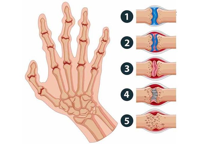 Stages of development of finger arthritis