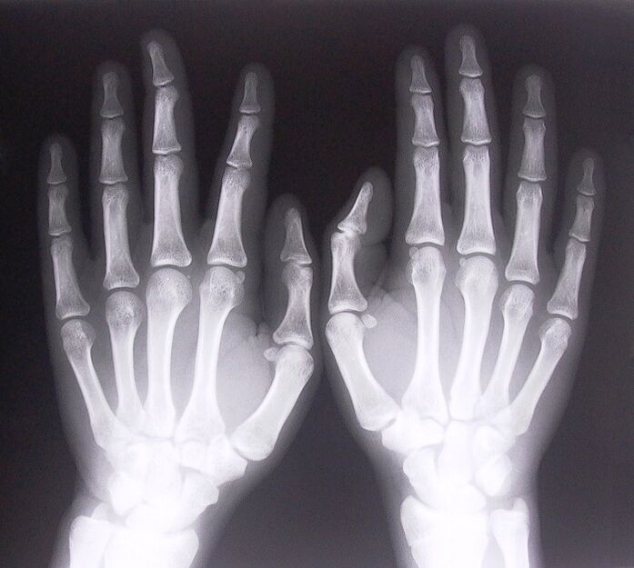 X-rays as a way to diagnose pain in finger joints