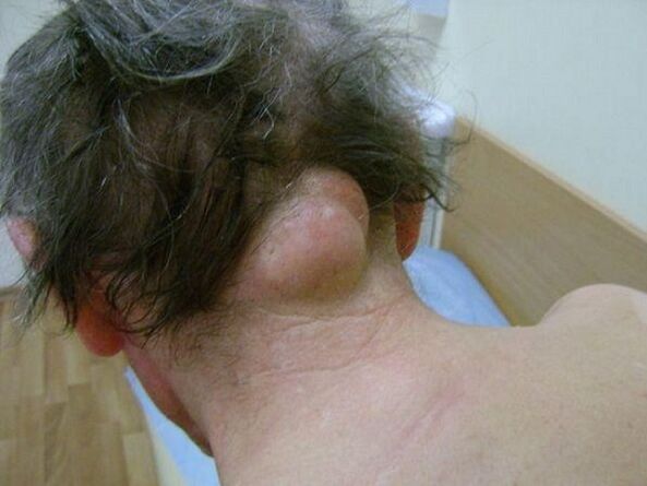 swelling in the neck is the cause of pain