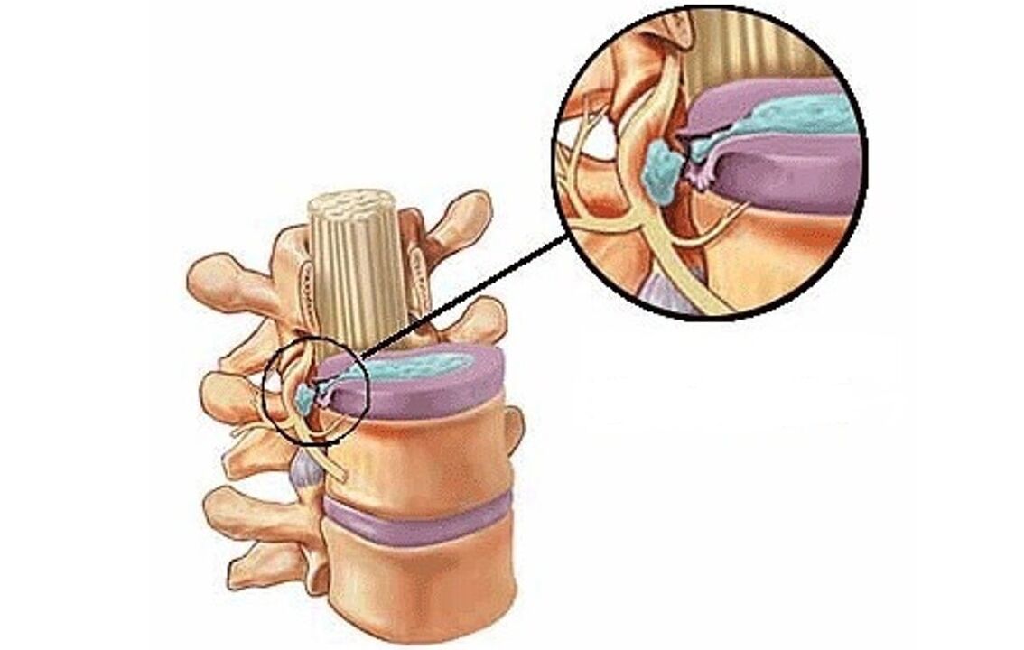 Disc herniation with cartilage degeneration in the chest area