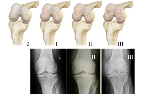 Diagnostic methods for knee osteoarthritis