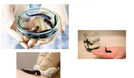 Hirud therapy for joint diseases