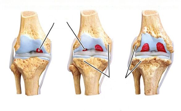 Stages of knee arthritis