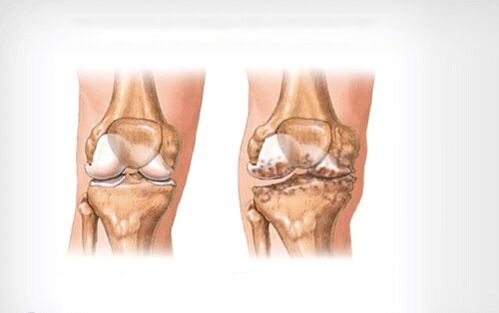 knee arthritis